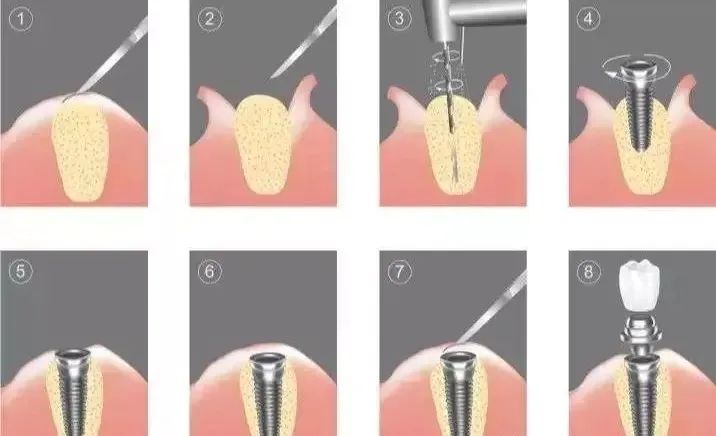 假牙为什么要叫做义齿,假牙为什么要换一个新牙
