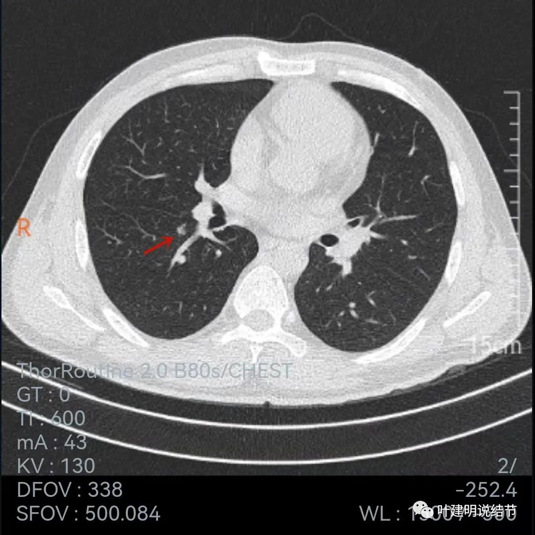 问诊分析：存在了4年的实性结节会不会是肺癌？