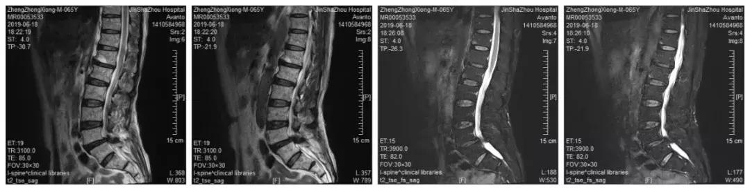 椎间盘突出和椎管狭窄症状的区别,腰椎管狭窄症的症状