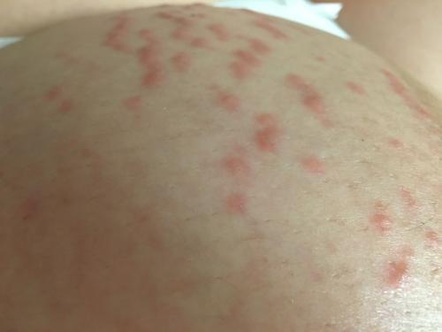 胃癌初期症状三处痒,胃癌的早期症状有三处疼痛