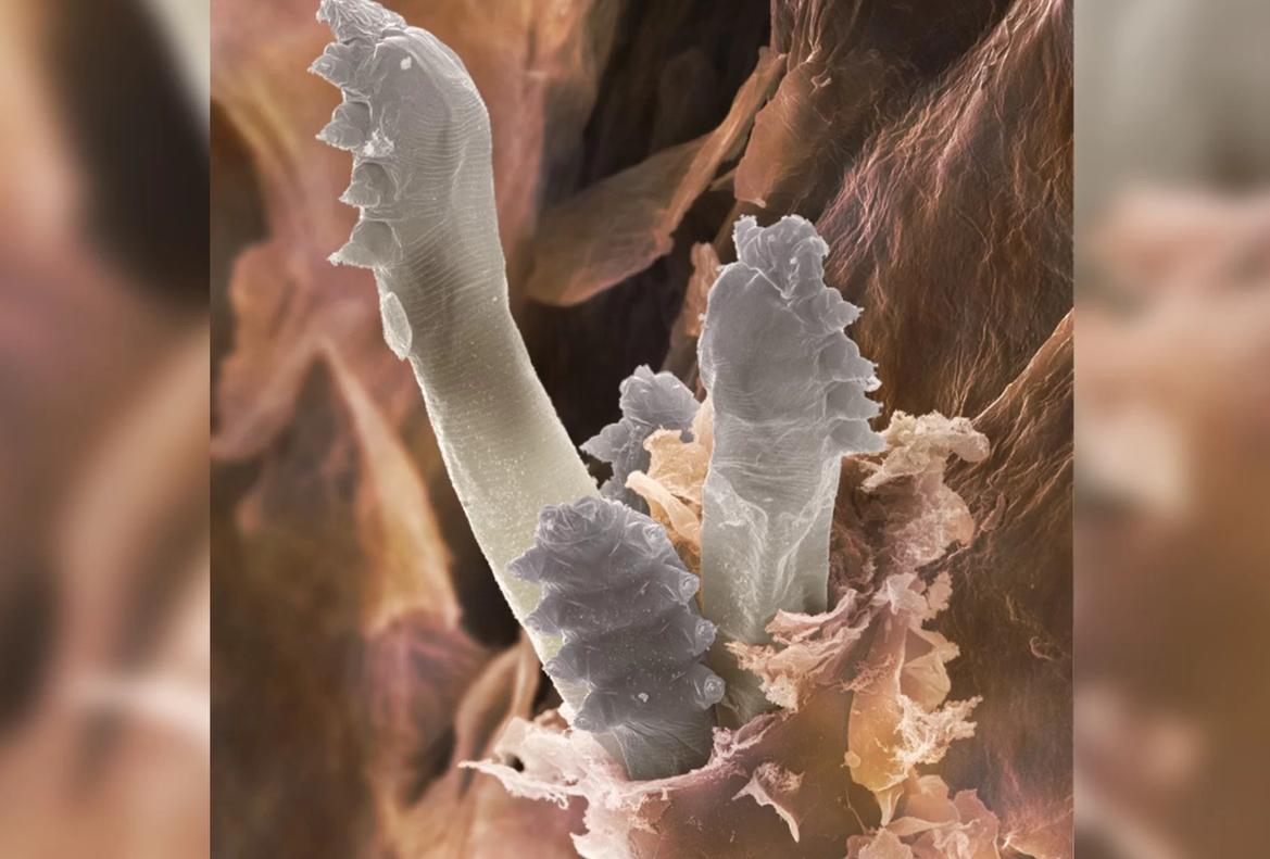 脸上的螨虫分泌物,脸部毛孔有螨怎么解决