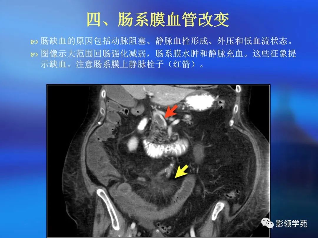 肠道内壁增厚,肠道扩张ct表现
