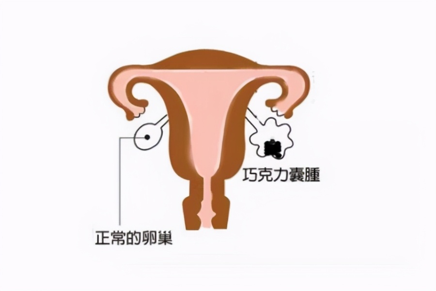 囊肿脓与淋巴脓的区别,液囊跟囊肿有什么区别