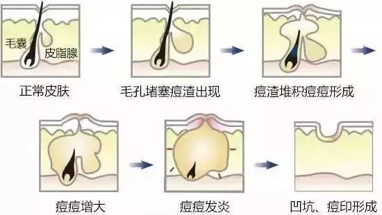 该怎样从源头上改善成人痘印痘坑,祛红痘印黑痘印医美