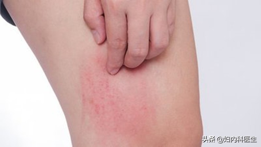 出现药物过敏症状应如何处理,药物过敏怎么才能查出来