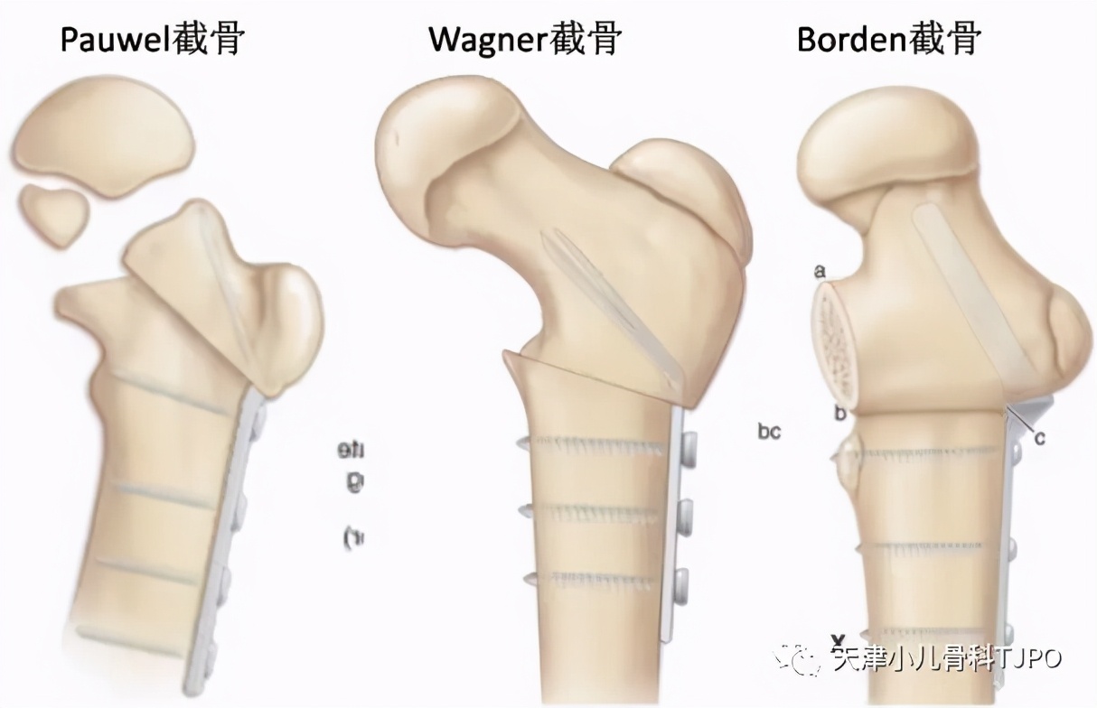 小儿先天性髋内翻名词解释,小孩走路颠足内翻