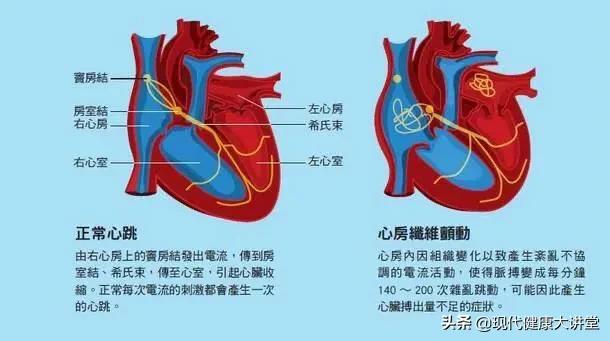 心房颤动的症状,心房颤动的临床特点