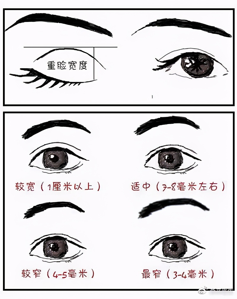 双眼皮修复科普,双眼皮修复要避免哪些坑