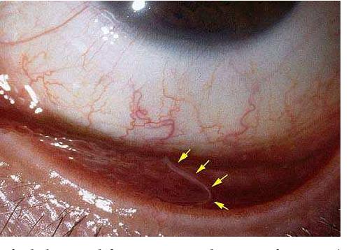 除了近距离接触宠物,不小心碰到苍蝇也可能让你眼中长虫