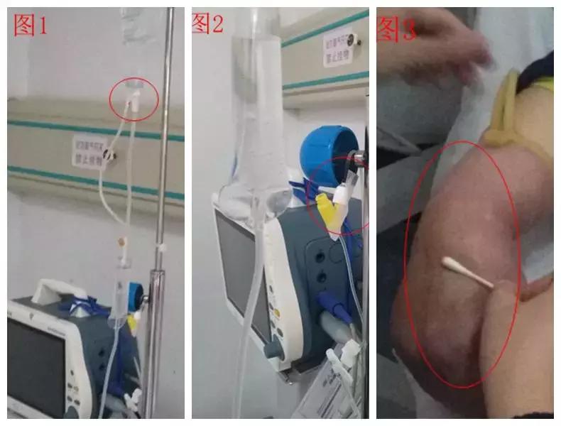 输血的这些错误操作，你有吗？