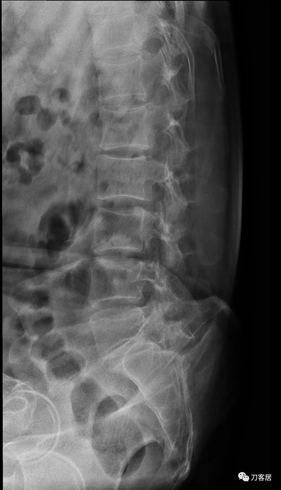 小针刀扎到坐骨神经会瘫痪吗,小针刀会切断坐骨神经吗