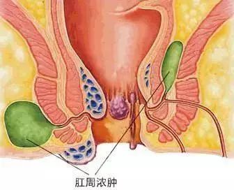 婴儿肛周脓肿最简单自愈方法,得了肛周脓肿怎么办