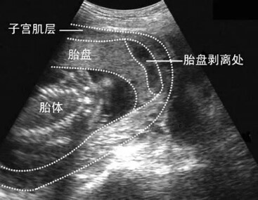 二胎妈妈每天都很难受,为什么感觉二胎假性宫缩很频繁