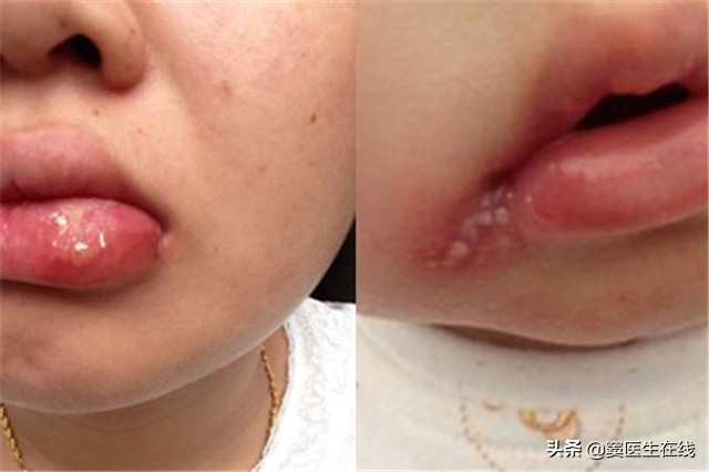 单纯疱疹到底是啥？对孩子身体有什么影响？家长不妨了解一下