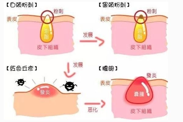 「丽皙白美肤」把闭口粉刺处理好，拒绝痘痘反复出现！