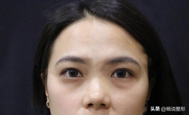 割完眼袋眼肿为什么,割完眼袋显得眼凶