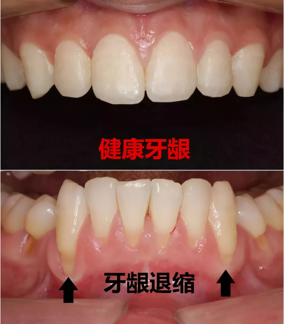 为什么牙龈会萎缩牙齿越来越小,牙龈为何萎缩如何补救