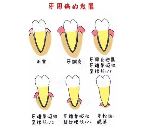 牙龈萎缩刷牙疼痛怎么办,牙龈萎缩刷牙就出血有办法治吗