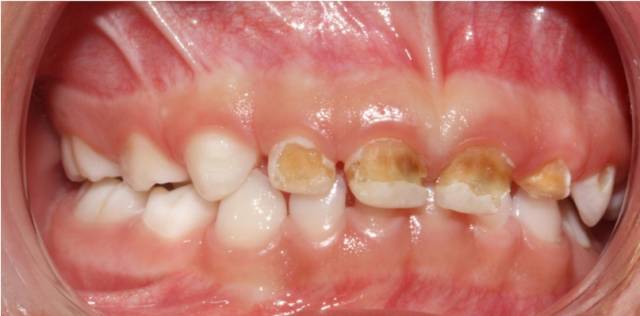 一个月宝宝口腔上颚白色的是什么,婴儿口腔上颚有一个小米样的白点