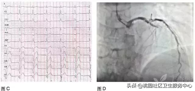 早期心梗心电图能查出来吗,警惕这种要命的心电图表现
