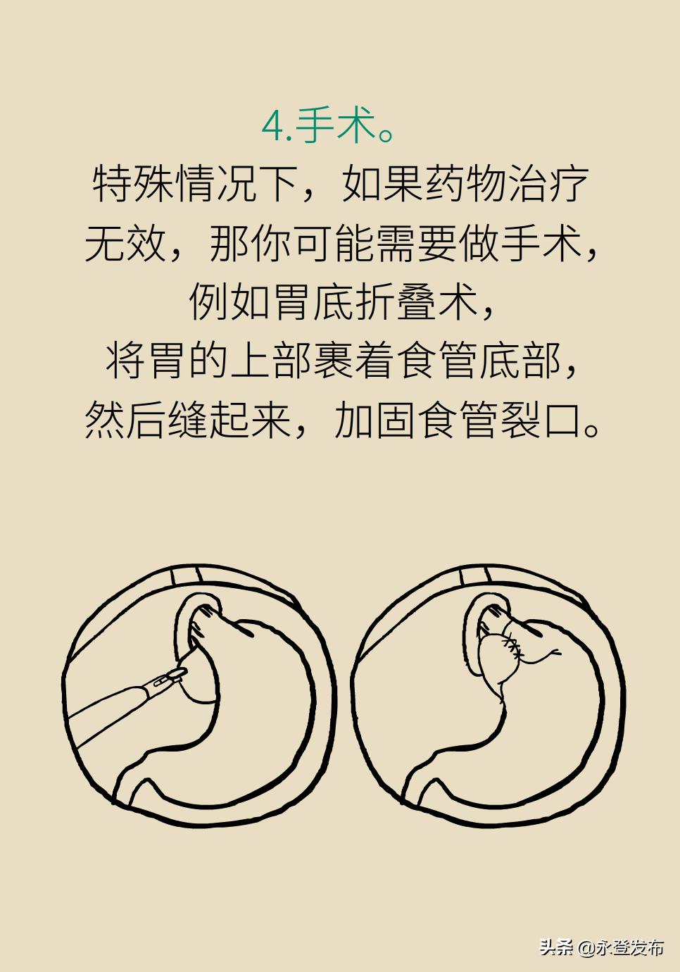 胃酸过多反酸烧心如何缓解,胃酸过多反胃烧心怎么办