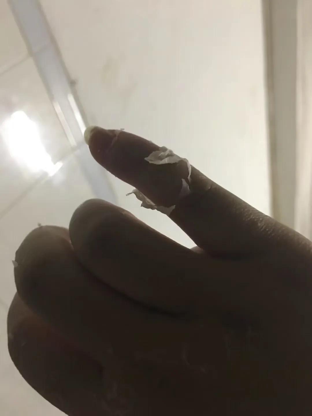 骨折人情冷暖,骨折后明白了人间冷暖