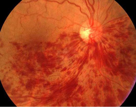 视网膜静脉阻塞急救护理措施,炎症引起视网膜静脉阻塞