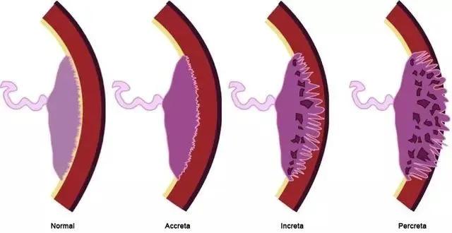 临床上最常见的异常胎盘,前置胎盘和低置胎盘超声