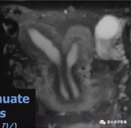 子宫发育异常,应想到的6大类常见畸形