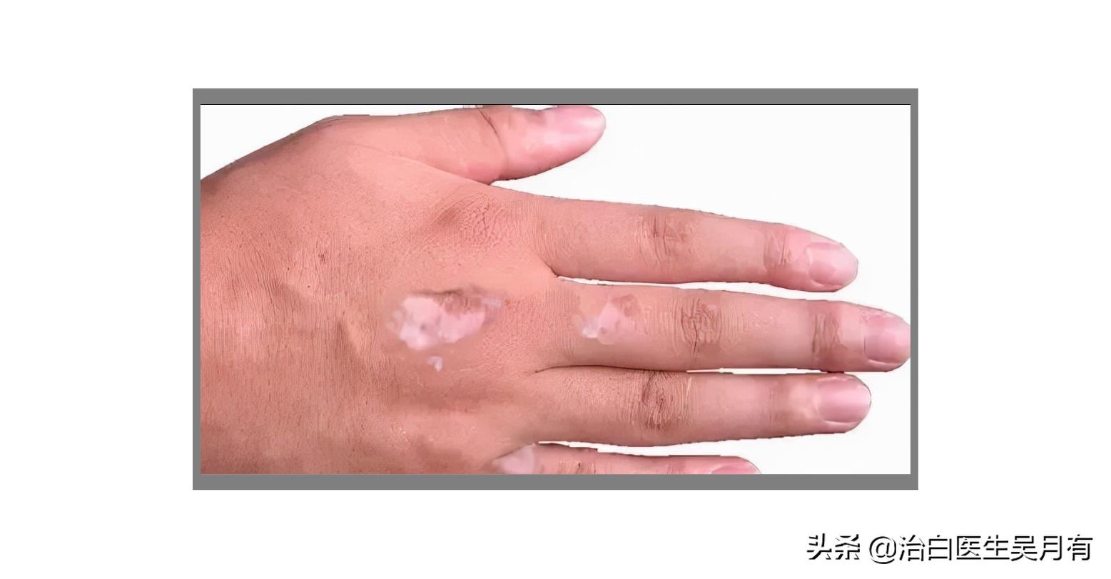 手部白癜风怎么鉴别,白癜风鉴别方法