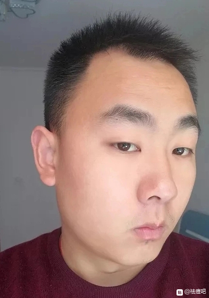 祛痘治疗后恢复,祛痘可以治好痘痘吗