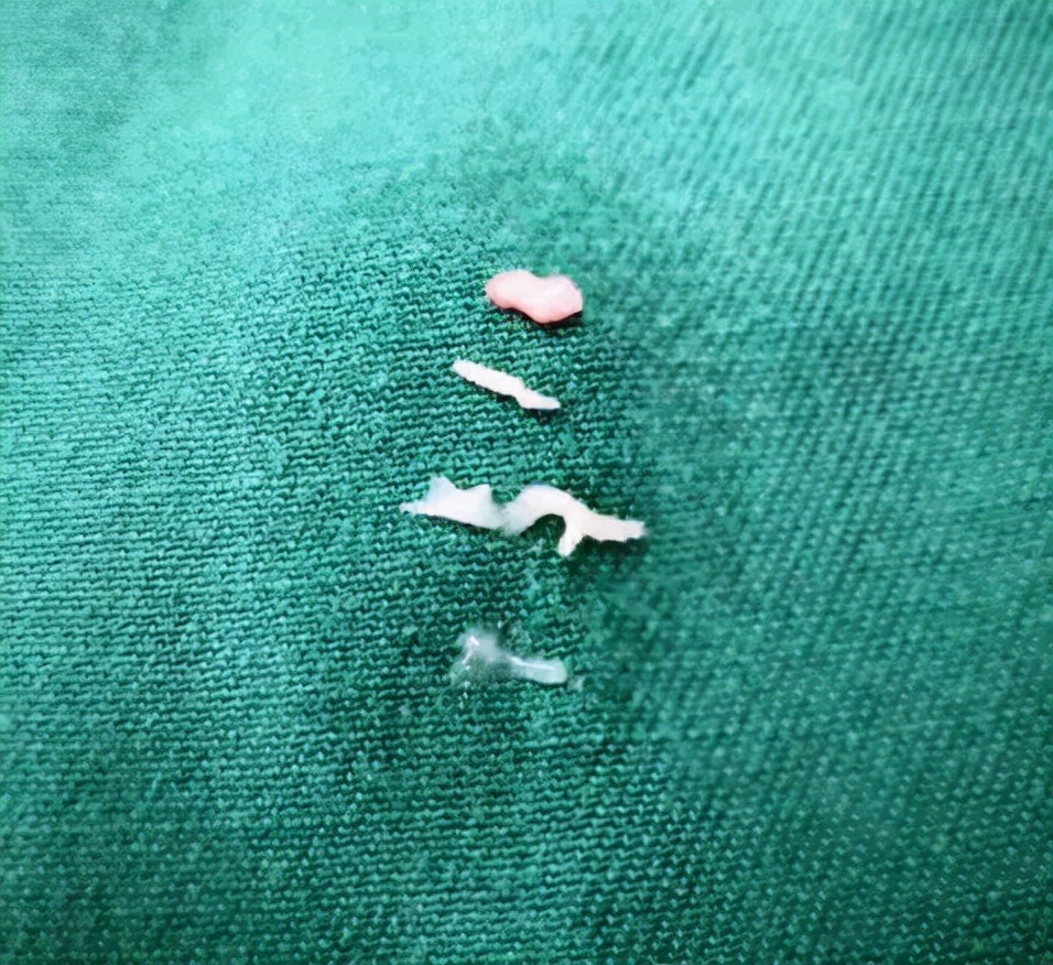 小孩肺炎支气管镜洗肺过程,肺炎总是不好怎么办