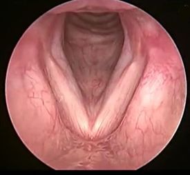 鼻腔发声的训练,矫正喉发声训练