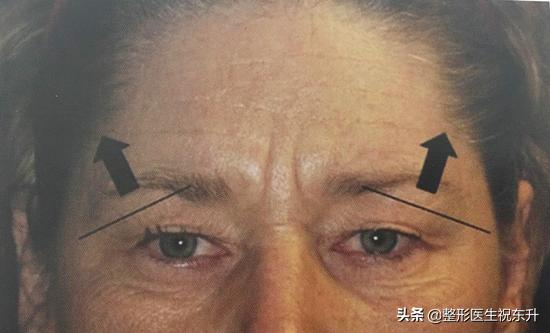 眉上内窥镜提眉视频全过程,内镜提眉