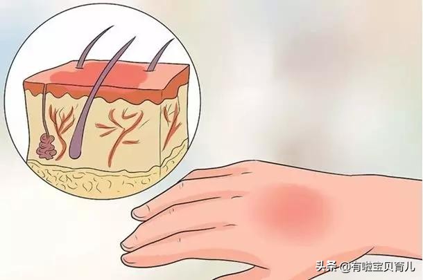 宝宝被烫伤第十三天,宝宝被开水烫伤要打针吗