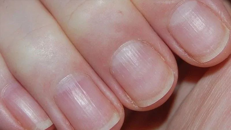 娃指甲上有白点是怎么回事,孩子指甲横纹有白点