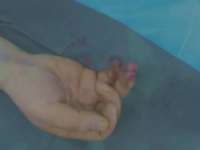 鎵嬫寚琚帇鏂簡,鎵嬫寚琚挗绠″紕鏂簡