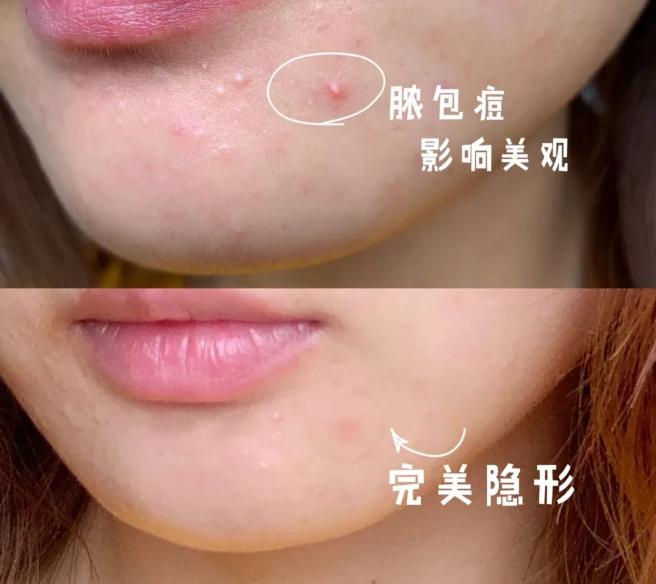 一撕一帖痘痘“隐形”，睡前贴一片，一觉醒来痘痘熟了