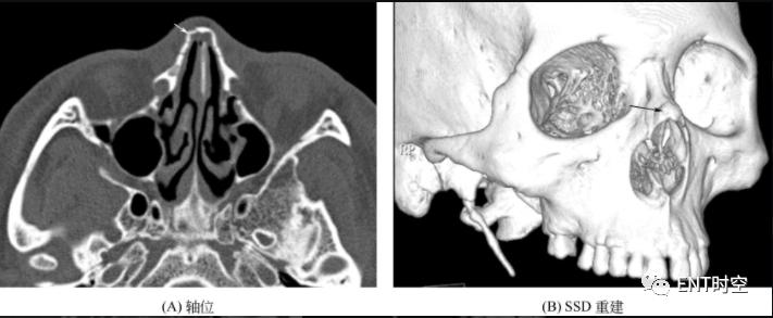 鼻骨骨折护理诊断及措施,鼻骨骨折怎么治疗最好
