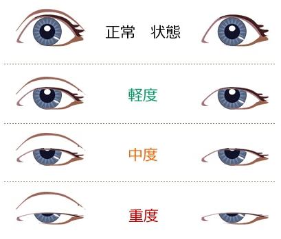 眼睛太圆了怎么修复双眼皮,眼睛已经是双眼皮太小了怎么变大