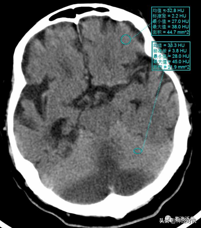 蛛血的临床表现,蛛血ct表现