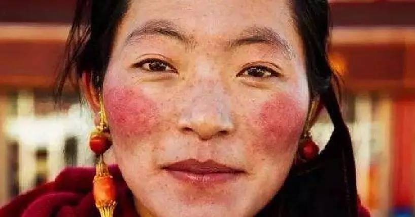 血丝斑点如何祛除,红血丝该怎么处理