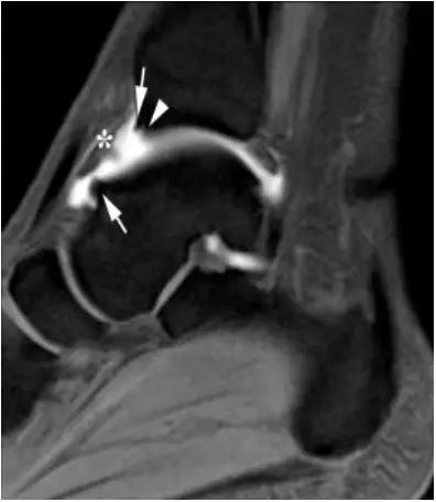 踝关节撞击症问诊,踝关节内侧撞击综合症位置图