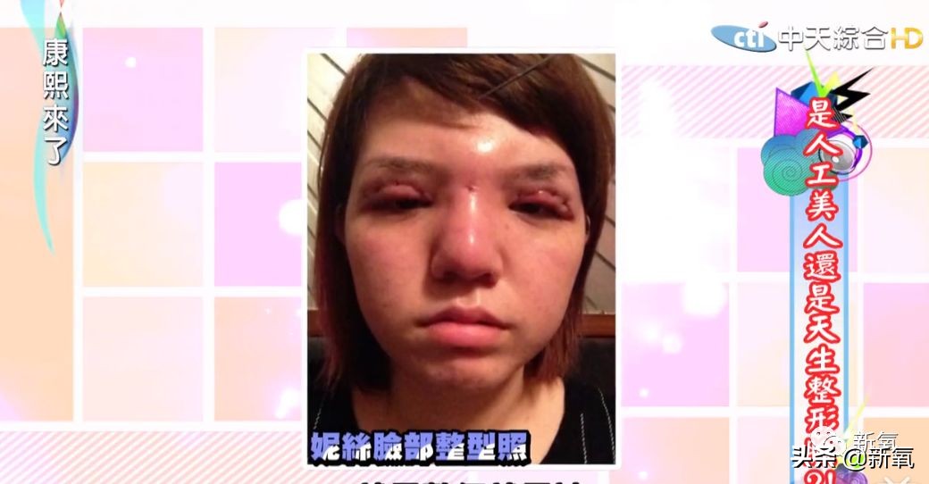 花90万从头整到脚,还可以这么自然?旁边纯天然小姐姐都看懵了