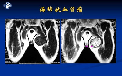 血管瘤的症状与危害70岁的老人,成人皮下血管瘤有什么症状和危害