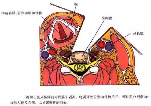 颈椎病是保守治疗还是手术治疗好,颈椎病做什么手术比较安全