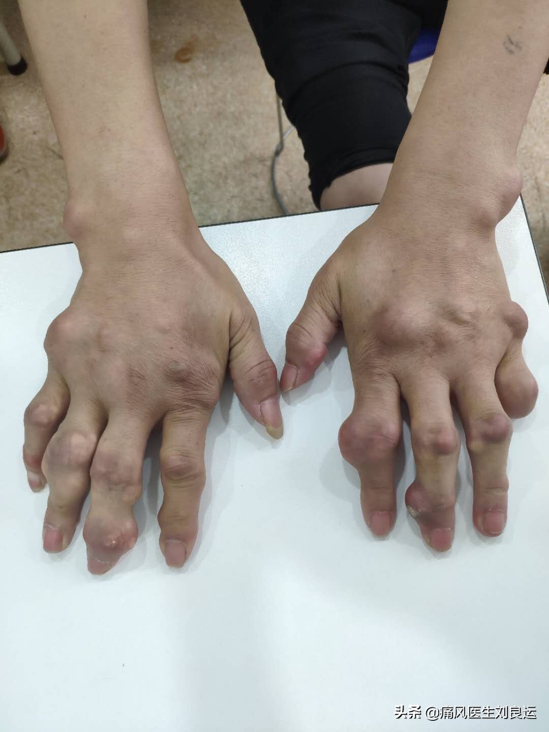 尿酸高痛风脚痛一般打什么针呢,尿酸高痛风脚痛一直不好怎么治