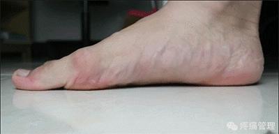 专门改善扁平足的运动,站着改善小腿外翻