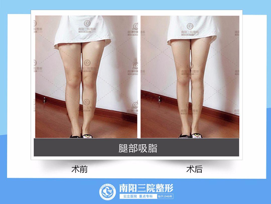 吸脂手术一秒变瘦,做了吸脂手术再减肥还能瘦么