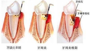 洗牙的过程是怎样的？洗牙有哪些注意事项呢？